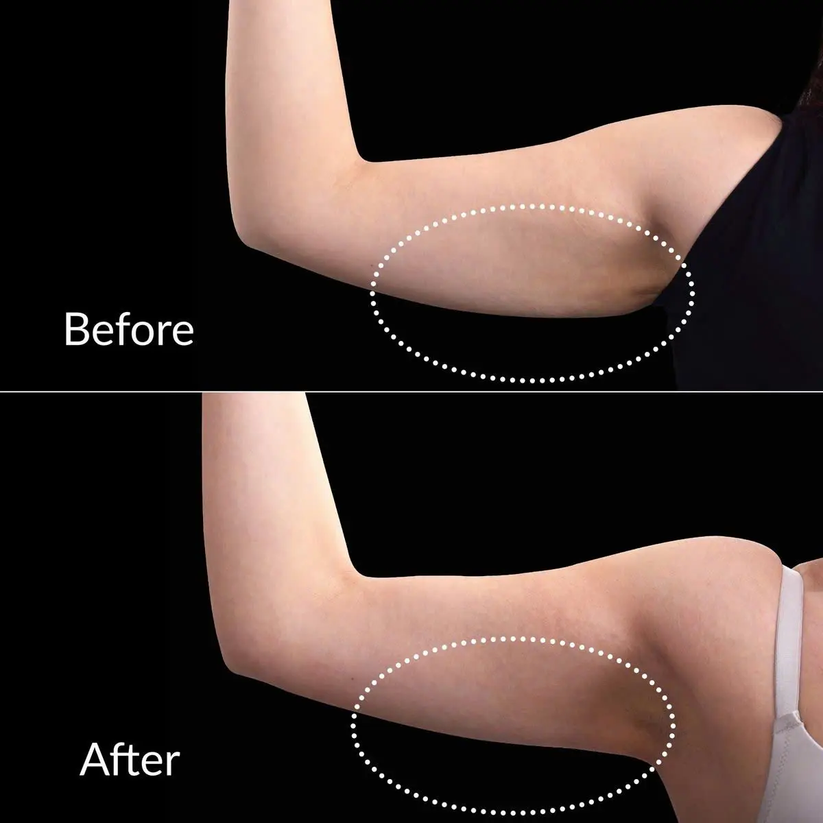 Arm Slimming Treatment