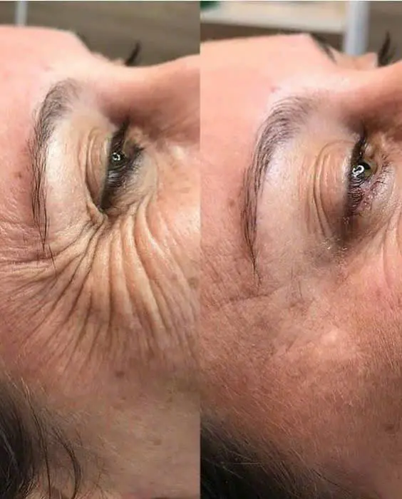 Botox – Eyes / Forehead