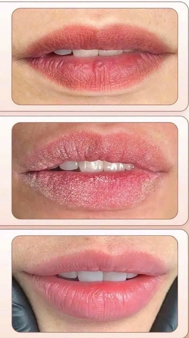 Laser CO₂ Lip Correction / Lip Perfection