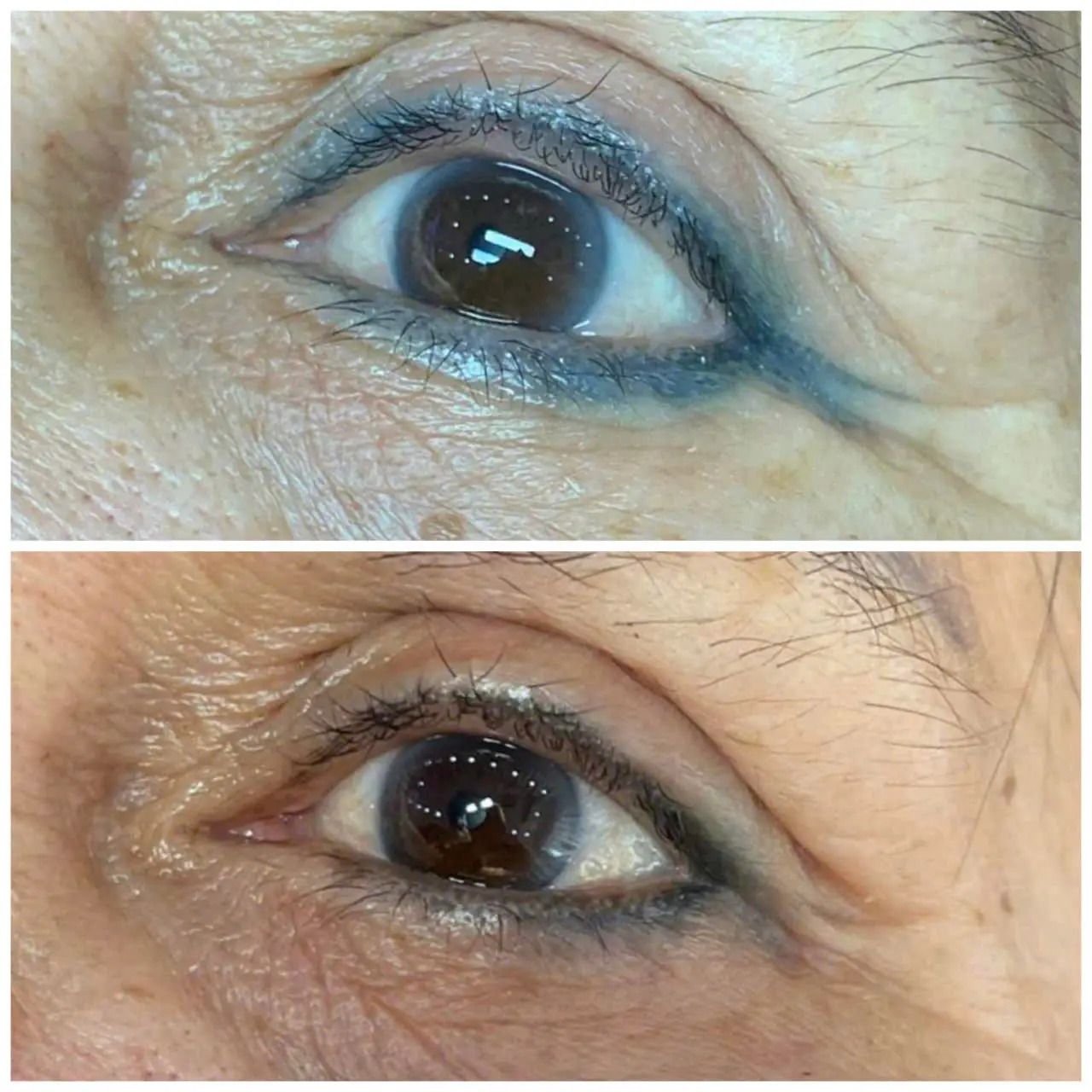 Laser PMU Removal – Eyeliner