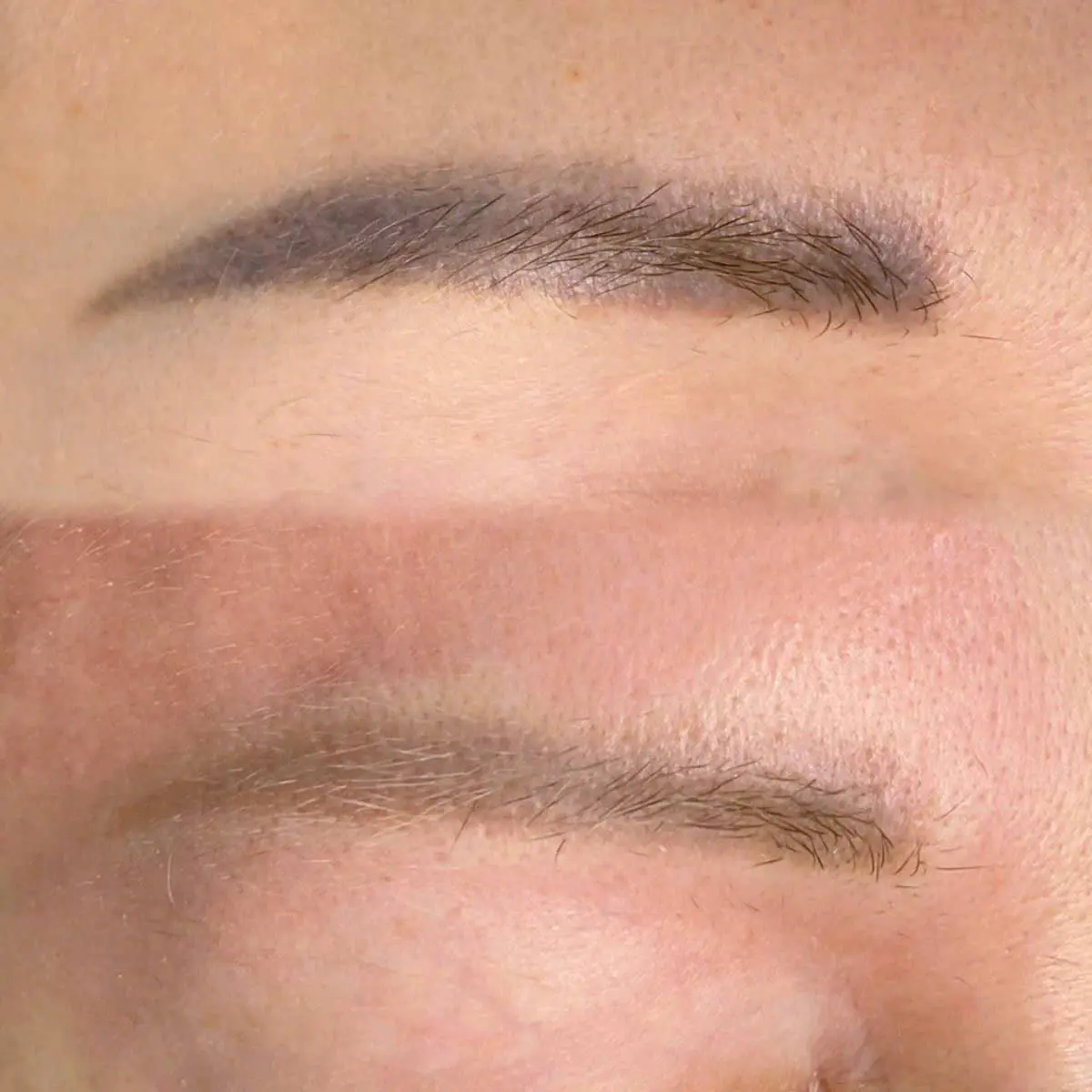 Laser PMU Removal – Brows